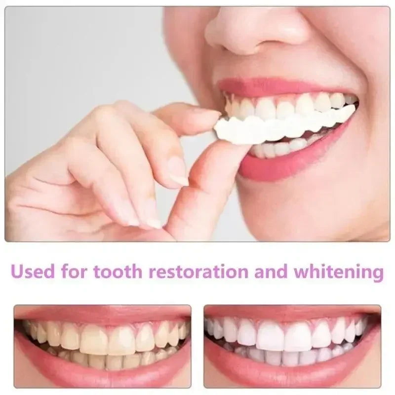 SmilePro™ — Facettes Dentaires Snap-On Ajustables