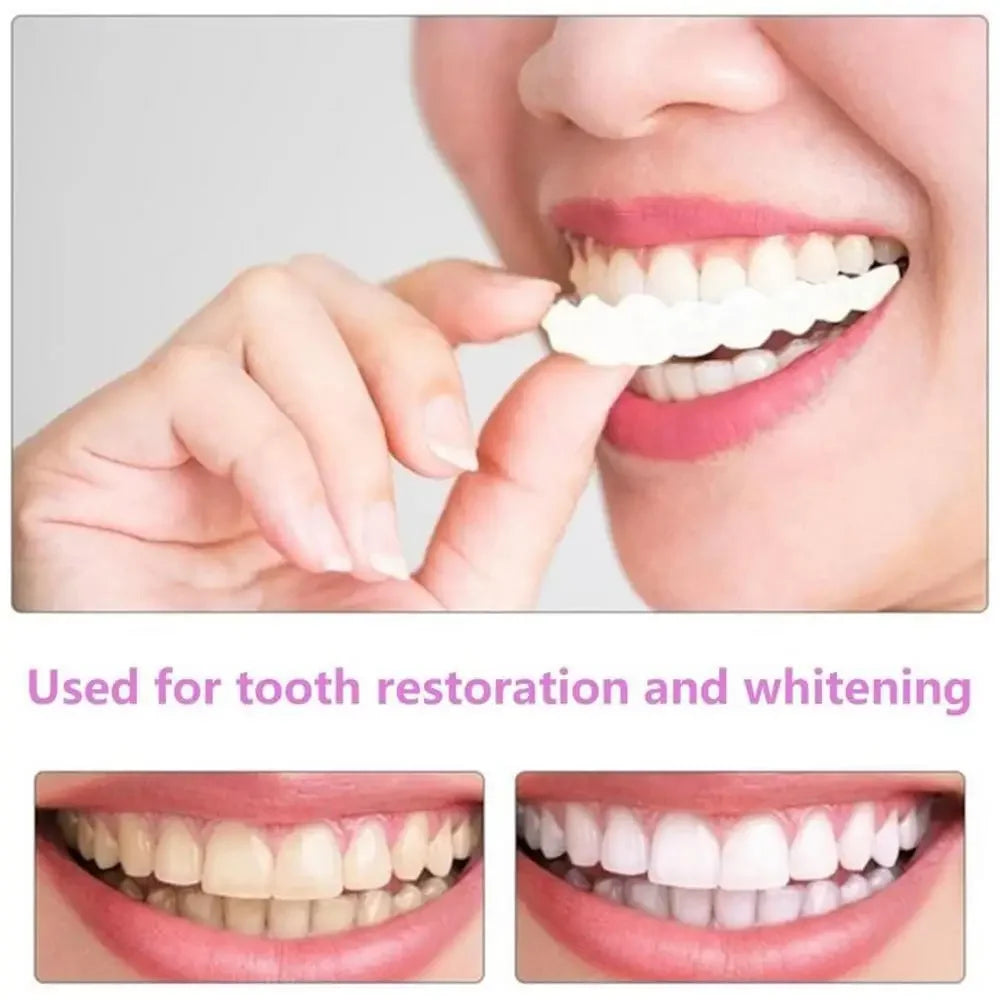 SmilePro™ — Facettes Dentaires Snap-On Ajustables